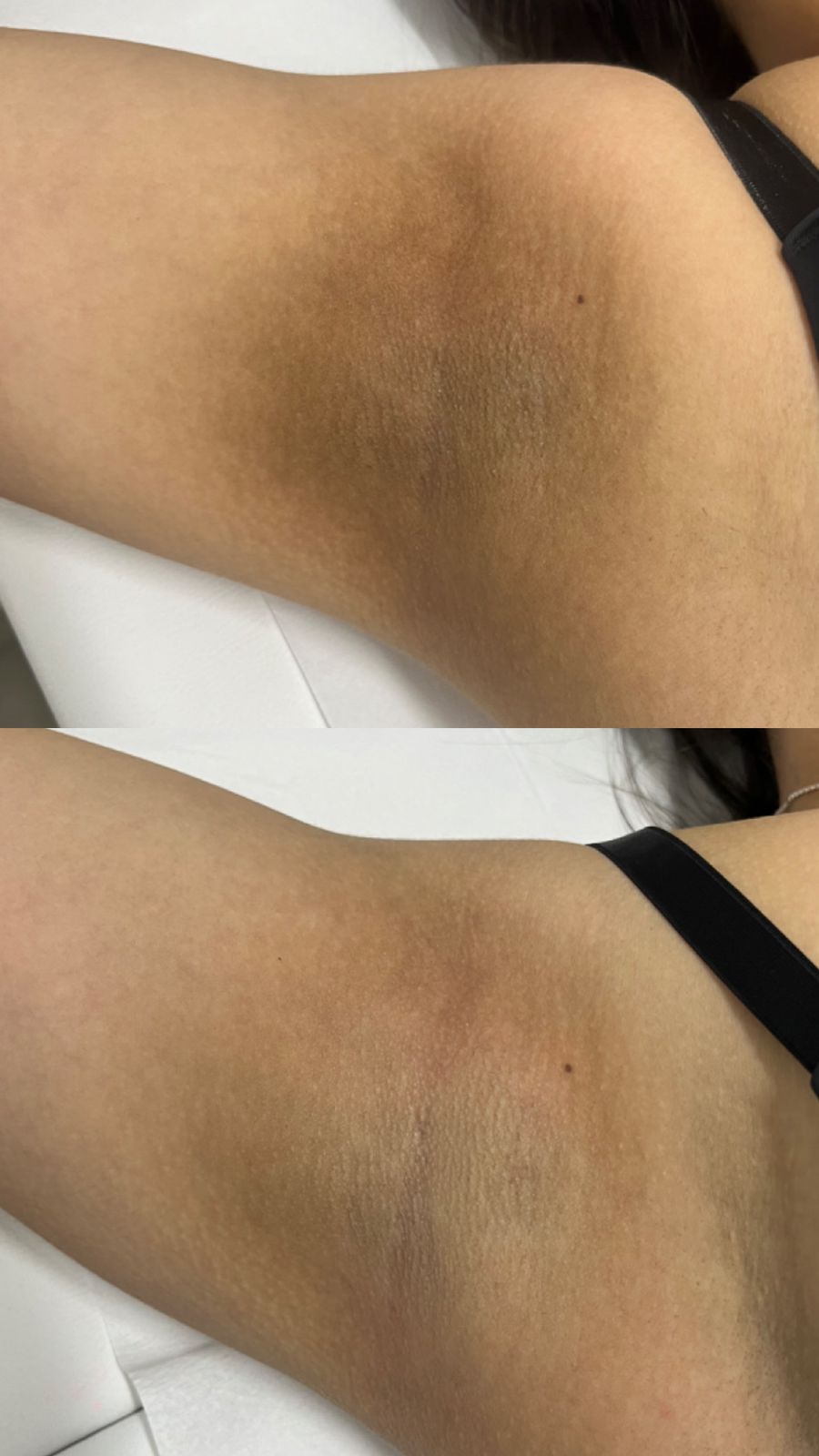 Antes e depois de tratamento na Depilei