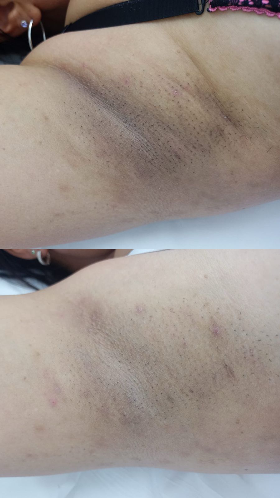 Antes e depois de tratamento na Depilei