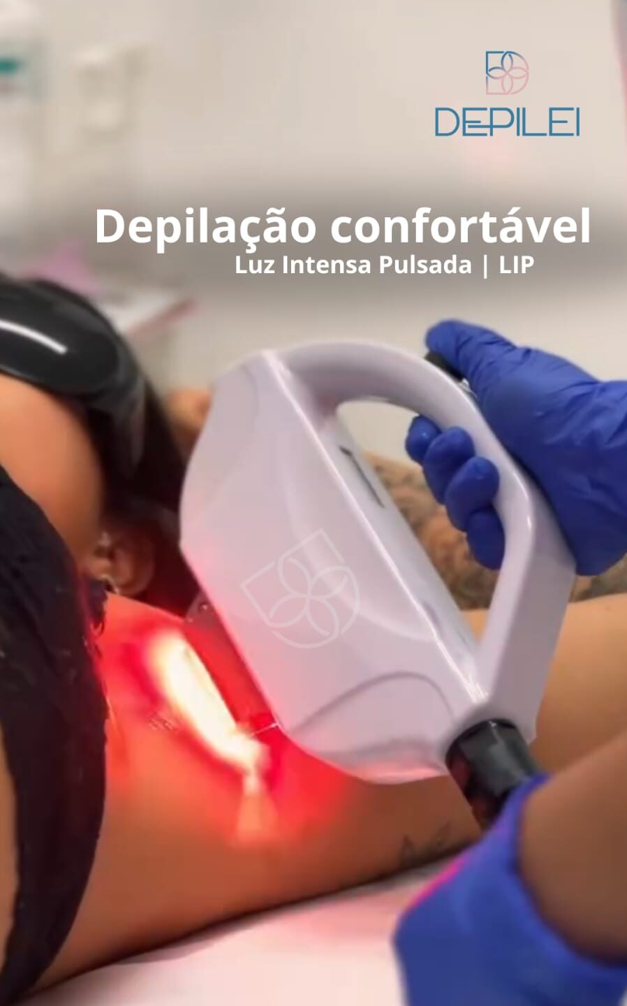 Depilação com Luz intensa pulsada no Centro de Criciúma | Depilei Centro de Estética Avançada Depilação