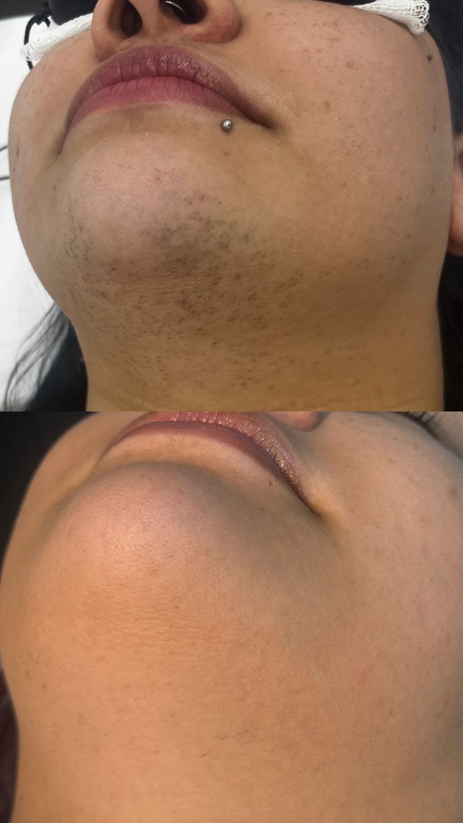 Antes e depois de tratamento na Depilei