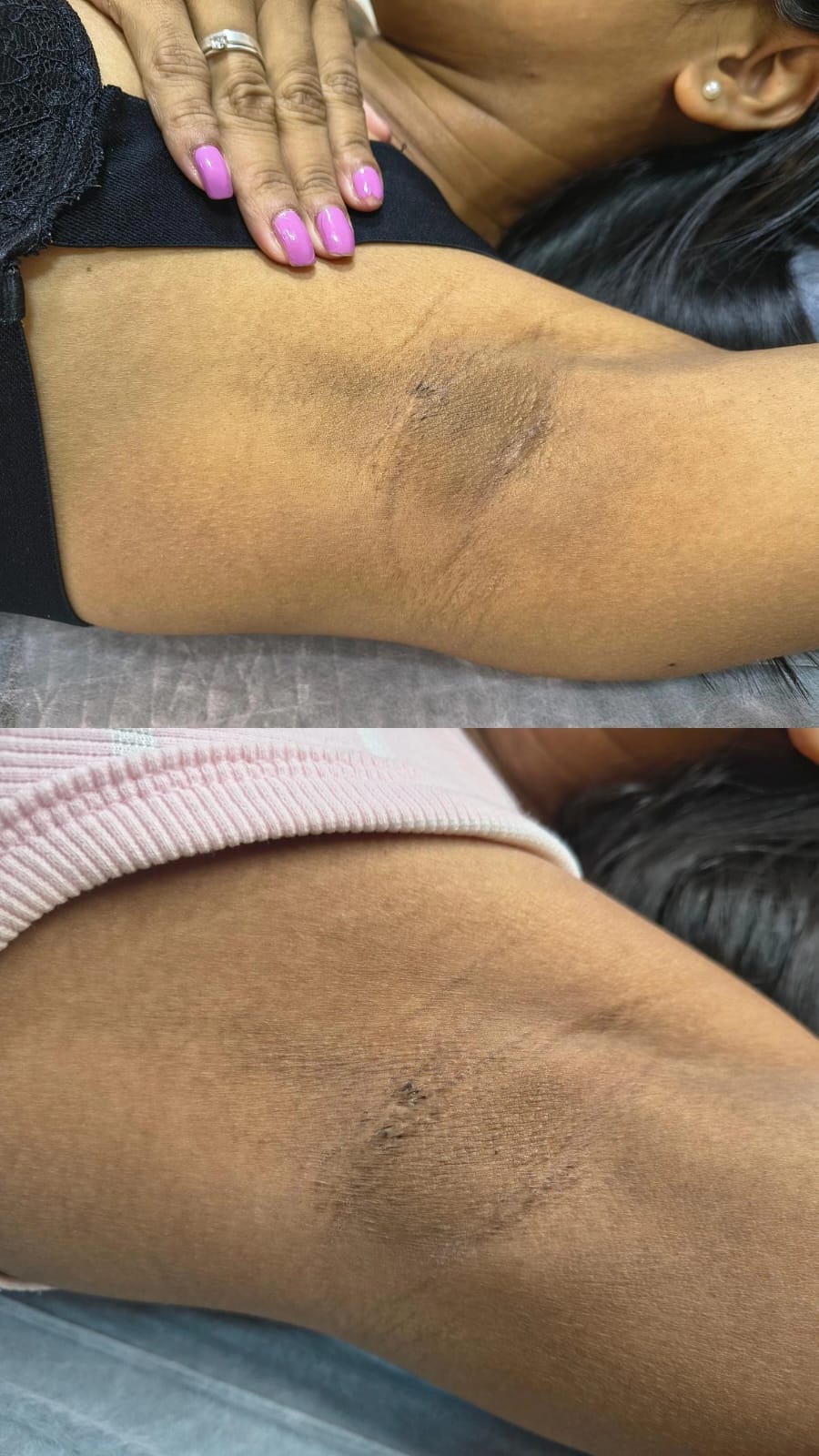 Antes e depois de tratamento na Depilei